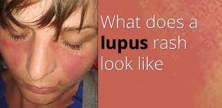 what does a lupus rash look like