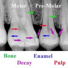 Image result for x-ray of teeth showing decay
