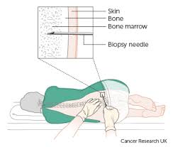 Image result for bone marrow biopsy procedure