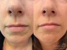 fixmyskin 1 hydrocortisone healing lip