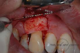 gum graft procedure care