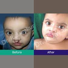 cleft lip and palate surgery at best