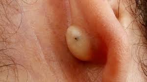 p or lump in or around the ear