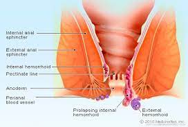 Internal hemorrhoids in females due to the pressure of the piles cause microcracks, which get moisture, sweat and cause pain. Internal And External Hemorrhoids Symptoms Treatment Pictures Causes