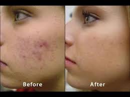 maenas before after acne scars