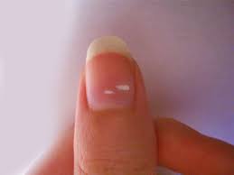 white spots on nails leukonychia