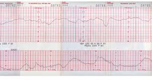 Normal Fetal Heart Rate By Week Things You Didnt Know