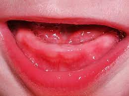 Часто прорезывание зубов у грудничков сопровождается болью, повышением температуры и даже воспалительными процессами. Chto Nuzhno Znat Roditelyam O Prorezyvanii Verhnih Zubov U Detej