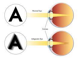 astigmatism exploring lasik other