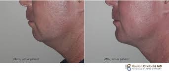 Generally, this procedure involves moving the lower jaw forward, though in some instances, the lower and upper jaws are both repositioned. Your Overbite Predisposes You To A Double Chin