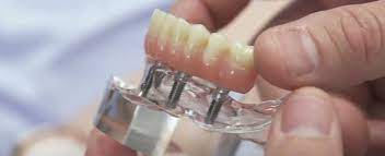 full mouth dental implants cost in