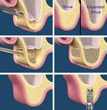 Image result for what is the cause of a person sinus to fall and a dentist lift them to put in apost