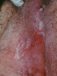 warts foothill dermatology