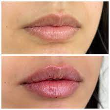 lip filler everything you need to