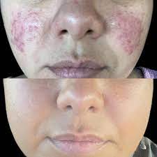 v beam pulsed dye laser lakes dermatology