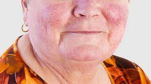 rashes and other lupus skin