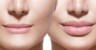 increase lip volume without surgery