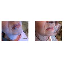 lip hemangioma gallery before and