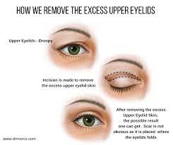removing excess upper eyelids skin