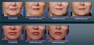 achieve full correction with restylane