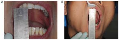 mandibular third molar extraction