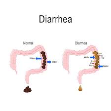 diarrhea guide causes symptoms and