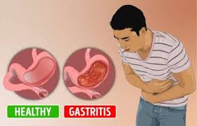 Di indonesia pada tahun 2009 tercatat 30.154 penderita gastritis yang menjalani rawat inap di rumah sakit prostaglandin merupakan hasil. Penyakit Asam Lambung Maag Atau Gerd Rumah Sakit Permata