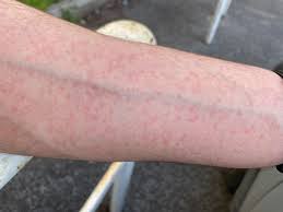 cholinergic urticaria an effective use