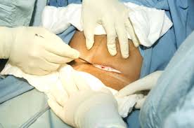 cesarean section procedure step by step