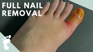 complete toenail avulsion you