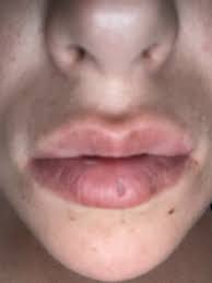 lower lip after punch biopsy photo
