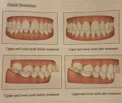 Overbites can even be acquired later in life from years of engaging in harmful habits like chewing on the fingernails. 9mm Overjet 3 Orthodontist Opinions Need Advice Braces