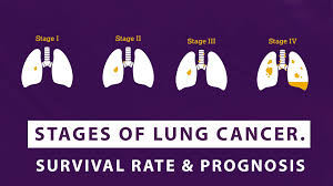 ses of lung cancer survival rate