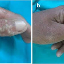 common warts before treatment