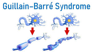 Typically, both sides of the body are involved. Guillain Barre Syndrome Gbs Youtube