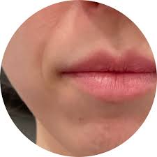 smile and lip line treatment the
