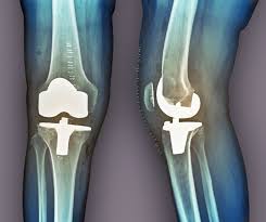 partial vs total knee replacement surgery