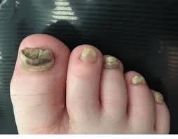 nail bed psoriasis in a child