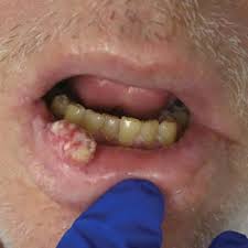 growing painful nodule on the lower lip