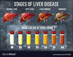 ses liver disease royalty free