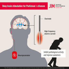 deep brain stimulation for parkinson s