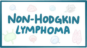 Non Hodgkin Lymphoma Causes Symptoms Diagnosis Treatment Pathology