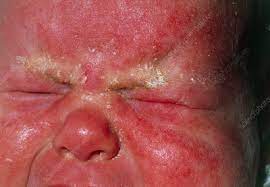 seborrhoeic dermais on baby s face