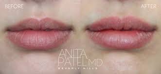 beverly hills lip fillers cosmetic