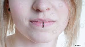 vertical labret piercing or lip ring