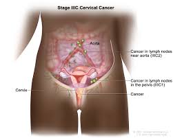 cervical cancer treatment pdq cancer