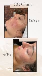 acne clinic cosmetic confidence