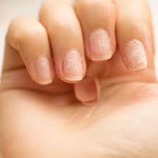 brittle nails causes symptoms