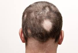 alopecia areata condition that causes