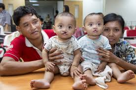 double the smiles cleft lip palate